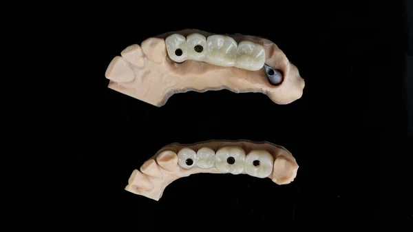 Тимчасові Зубні Мости Після Імплантації Розміщення Барної Стійки — стокове фото