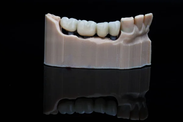 Ponte Dentária Temporária Coroas Dentes Posteriores Modelo Resina Filmado Vidro — Fotografia de Stock