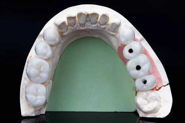 Ceramic Crowns Plaster Model Top View Black Background — Stock Photo, Image