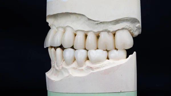 Ceramic Crowns Models Upper Lower Jaw Bite — Stock Photo, Image