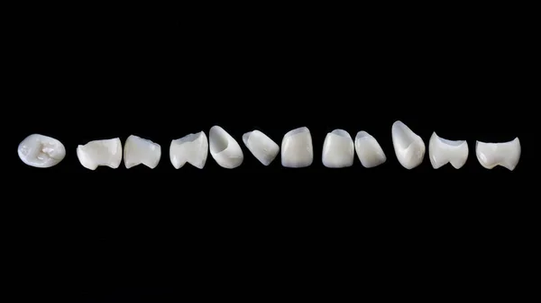 Folheados Dentários Mandíbula Superior Feita Cerâmica Sobre Fundo Preto Vista — Fotografia de Stock