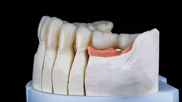 下の顎の冠が一時的に黒い背景で撮影された歯科モデルです — ストック写真