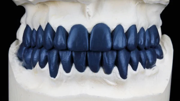 Wosk Niebieskiego Wosku Górnych Dolnych Szczęk Modele Bite Czarnym Tle — Zdjęcie stockowe