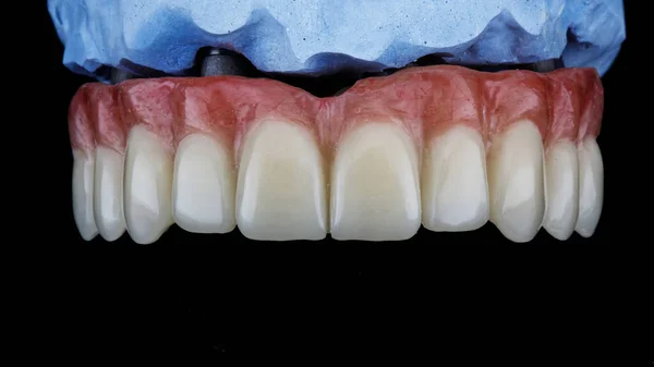 Model Üzerinde Yapay Sakız Ile Üst Çene Için Diş Protezi — Stok fotoğraf