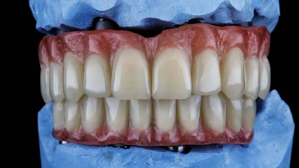 Diş Protezleri Siyah Arka Plandaki Isırıkta Kapanmış — Stok fotoğraf