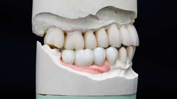 Coroas Dentárias Feitas Diferentes Materiais Tons Diferentes Modelo Gesso Vista — Fotografia de Stock