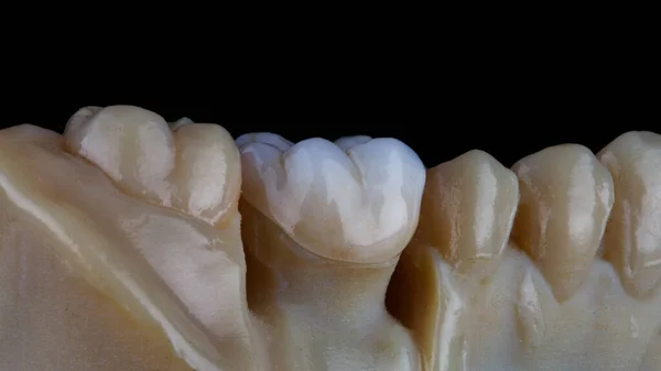 Koronę Cyrkonową Zęba Żucia Modelu Żywicy Czarnym Tle — Zdjęcie stockowe