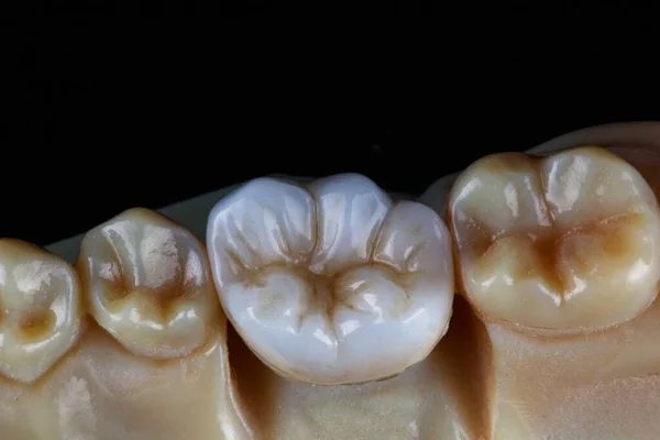 3Dプリンタで作成されたモデル上から黒い背景で撮影された噛む歯のジルコンクラウン — ストック写真