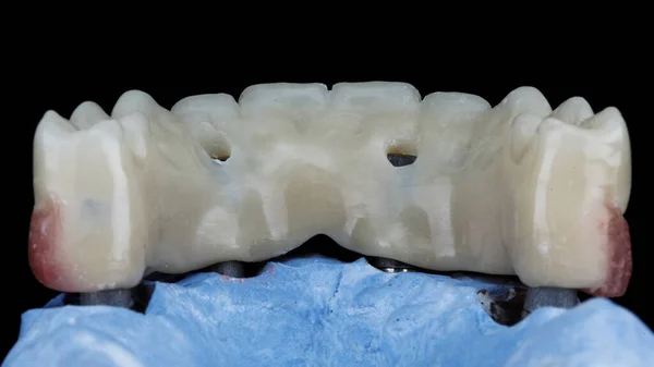 Dental Prosthesis Made Polymer Upper Jaw View Model Filmed Black — Stock Photo, Image