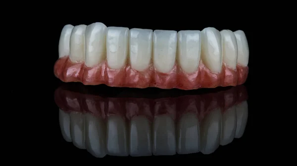 Prótese Mandíbula Inferior Com Gengiva Vermelha Artificial Dentes Brancos Brilhantes — Fotografia de Stock