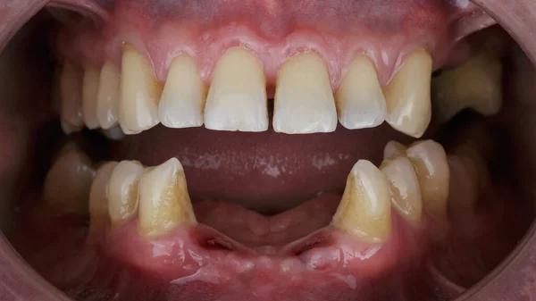 Mandíbula Sin Tres Cuatro Dientes Inferiores —  Fotos de Stock