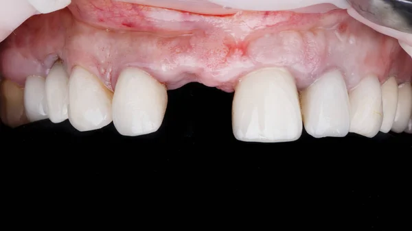 Άνω Κοιλιακός Κόλπος Ασθενούς Χωρίς Κεντρικό Δόντι Πριν Την Εμφύτευση — Φωτογραφία Αρχείου