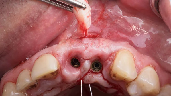 Hinzufügen Von Weichgewebe Zahnfleisch Für Volumen Nach Zahnimplantation — Stockfoto