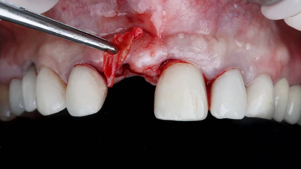 歯中央部の移植後に歯に軟部組織を追加する瞬間 — ストック写真