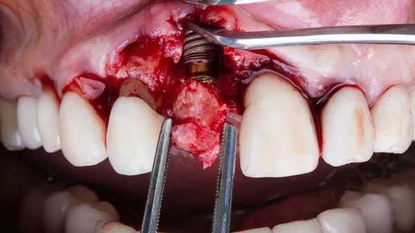注入後の歯の中心部に骨の断片を追加します — ストック写真