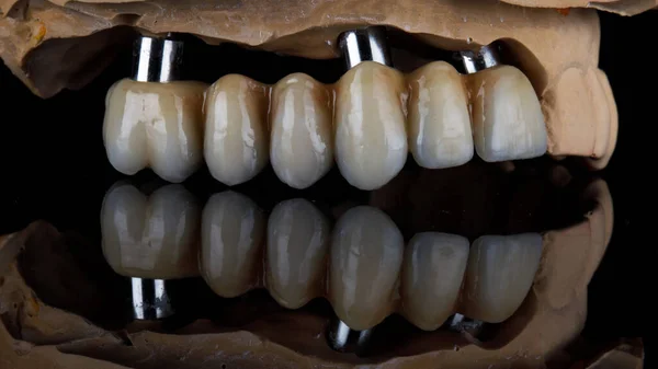Ponte Dental Cerâmica Modelo Gesso Filmado Vidro Preto — Fotografia de Stock