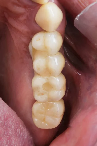 Ceramic Bridge Separate Crown Installed Patient Gum Cavity — Stock Photo, Image