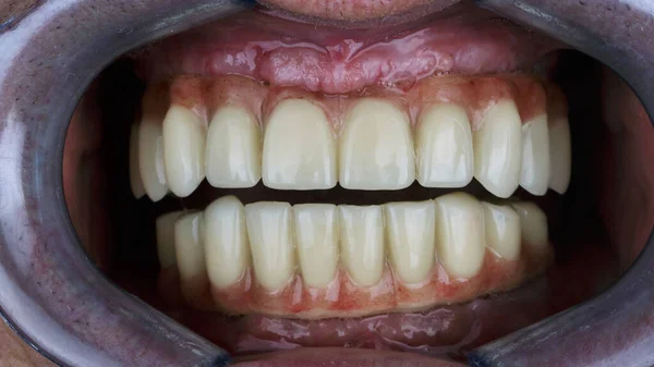 Duas Próteses Dentárias Mandíbula Superior Inferior Cavidade Oral — Fotografia de Stock