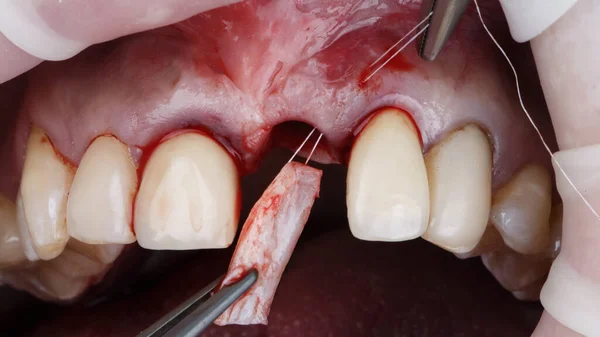 Momento Dell Aggiunta Lembo Tessuto Molle Dopo Impianto Dentale — Foto Stock