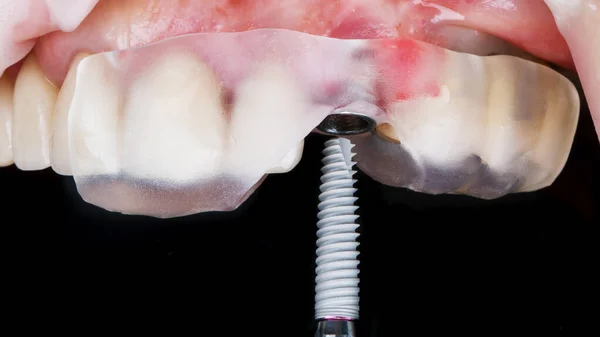 Kesinlik Için Cerrahi Şablon Ile Yerleştirmeden Önce Diş Implantı — Stok fotoğraf