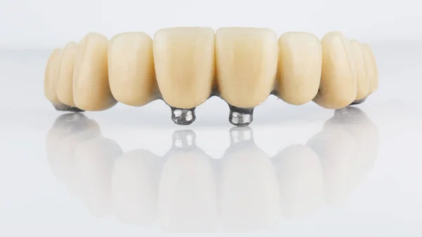 Proteza Zębów Całą Szczękę Górną Makro Zdjęcie Białym Tle — Zdjęcie stockowe