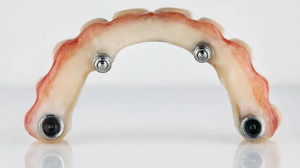 Excelente Foto Sobre Prótese Dentária Mandíbula Superior Arco Foi Filmado — Fotografia de Stock