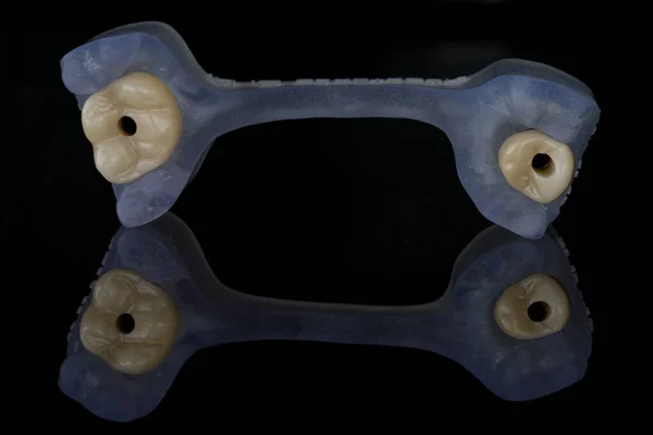 Piękne Korony Dentystyczne Wykonane Ceramiki Czarnym Lustrze Twórczym Odbiciem — Zdjęcie stockowe