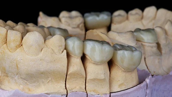 Wkłady Ceramiczne Modele Gipsowe Zęby Żucia — Zdjęcie stockowe