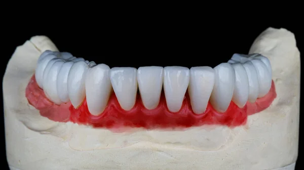 Folheados Dentários Feitos Cerâmica Mandíbula Inferior Modelo Gesso Com Gengivas — Fotografia de Stock
