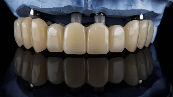 Estetická Provizorní Zubní Protéza Horní Čelisti Modelu Tyčí Filtrovaná Černém — Stock fotografie