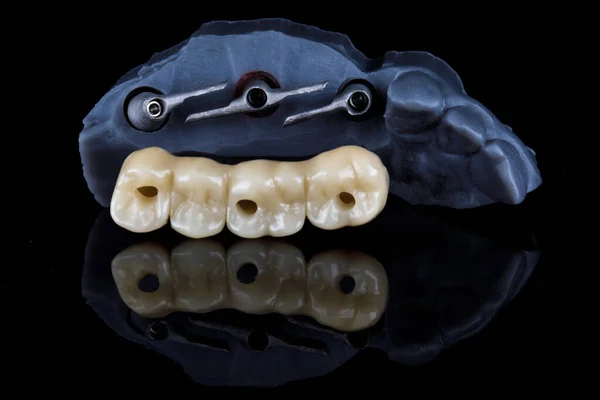 歯と黒の背景にロードするためのバーの噛む歯の橋 — ストック写真