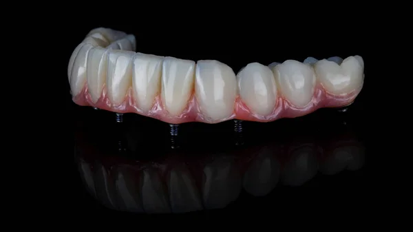 黒い背景に下顎の歯茎を持つセラミック歯科補綴物 — ストック写真