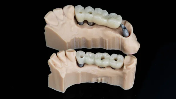 Dos Puentes Dentales Sobre Modelos Dentales Uso Temporal Disparados Contra —  Fotos de Stock