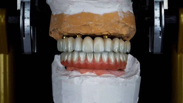 セラミックとチタンで作られた2つの歯科用プロテーゼで構成されています — ストック写真