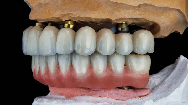 Two Dental Prostheses Made Ceramic Titanium Articulator Bite Side View — Stock Photo, Image