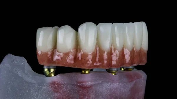 Prótese Dentária Mandíbula Inferior Com Uma Gengiva Natural Modelo Odontológico — Fotografia de Stock