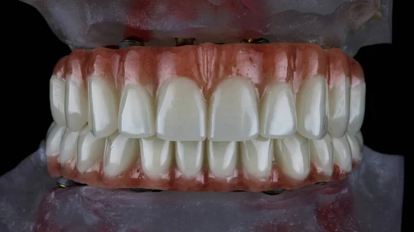 Próteses Dentárias Para Ambas Mandíbulas Modelos Mordida Filmado Fundo Preto — Fotografia de Stock