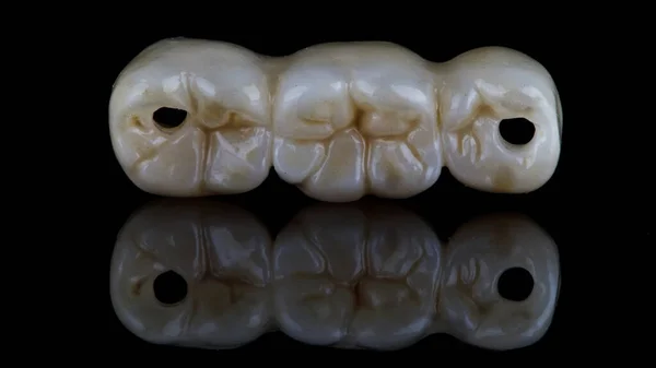 Ponte Dental Para Três Dentes Feitos Zircão Vidro Preto Com — Fotografia de Stock