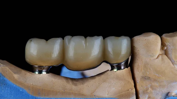 Pont Dentaire Dents Zircon Couleur Naturelle Sur Barre Titane — Photo