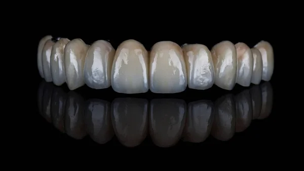 Hermosa Prótesis Dental Mandíbula Superior Hecha Cerámica Alta Calidad Filmada —  Fotos de Stock