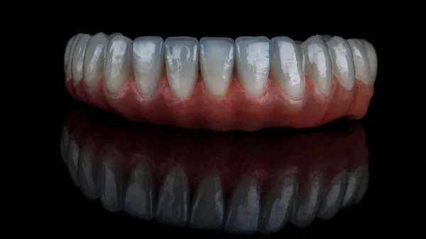 Prótese Dentária Mandíbula Inferior Cerâmica Alta Qualidade Sobre Fundo Preto — Fotografia de Stock