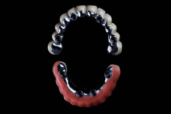 チタン製の歯の梁にセラミック 黒い背景の上からの眺め — ストック写真