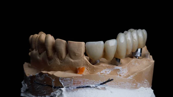 Puente Dental Cerámica Sobre Mitad Mandíbula Superior Filmado Sobre Fondo —  Fotos de Stock