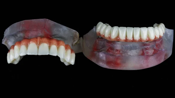 黒の背景に人工ガムのある顎の2本の歯の義歯 — ストック写真