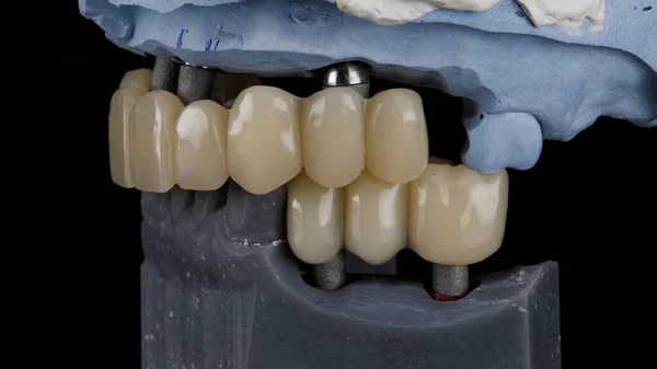 Puente Dental Prótesis Resina Sobre Modelo Dental — Foto de Stock