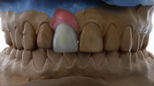 Composição Modelo Dentário Coroa Cerâmica Incisivo Central Feita Cerâmica Alta — Fotografia de Stock