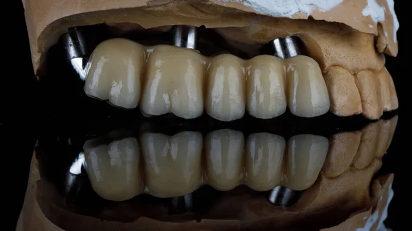 チタンバーのセラミック歯科橋反射モデルに取り付けられ — ストック写真
