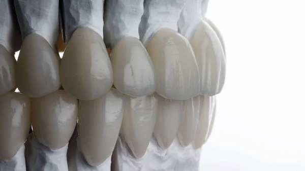 beautiful ceramic dental veneers for the upper and lower jaws, beautiful composition on a white background
