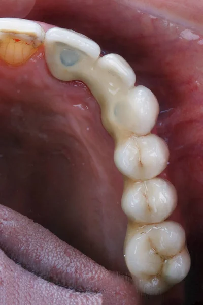 Tandprotes För Halva Käken Patientens Mun — Stockfoto