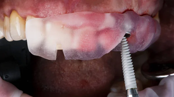 dental implant before installation through a dental template